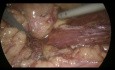Procedimiento laparoscópico de Hartmann para la diverticulitis perforada