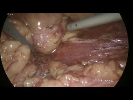 Procedimiento laparoscópico de Hartmann para la diverticulitis perforada