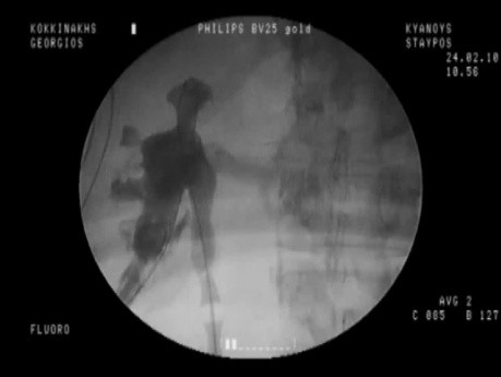PCNL - Complicaciones