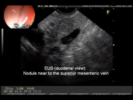 Diagnóstico de insulinoma mediante EUS