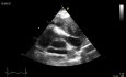 Ecocardiograma transesofágico - obstrucción en la vía de salida del ventrículo derecho - masa del mediastino.