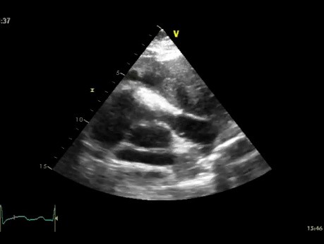 Ecocardiograma transesofágico - obstrucción en la vía de salida del ventrículo derecho - masa del mediastino.