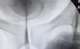 Dilatación con balón de estenosis uretral complicada