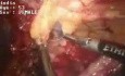 Adhesiolisis - cirugía laparoscópica