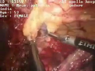 Adhesiolisis - cirugía laparoscópica