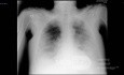 Radiografía de tórax - COVID-19 (1)