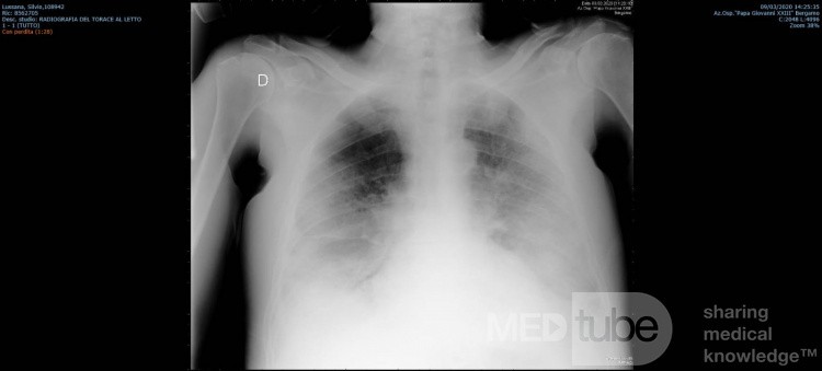 Radiografía de tórax - COVID-19 (1)