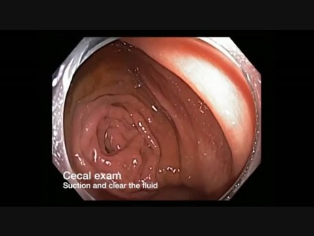 Canal de colonoscopia - lesión sutil observada después de la succión de líquido
