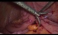 Ileotransversostomía laparoscópica paliativa