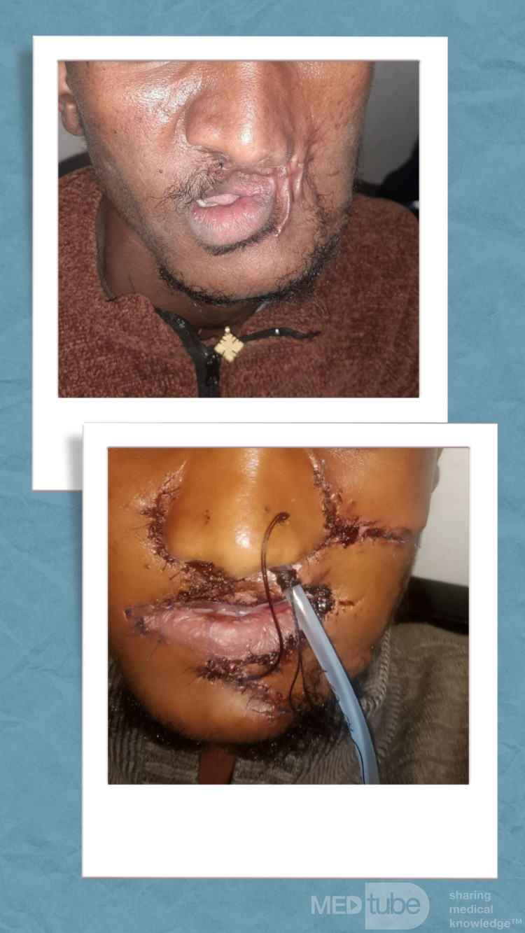 Defecto residual por herida de arma de fuego con retracción nasal por cicatriz hipertofica y microstomia