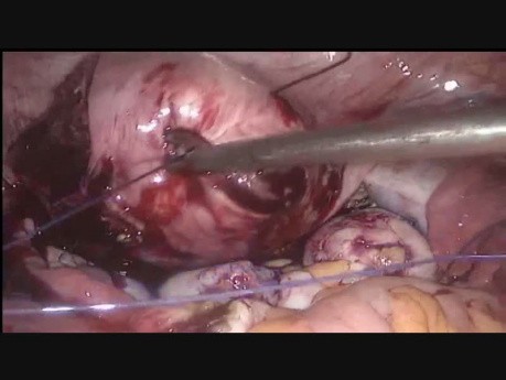 Miomectomía de numerosos miomas uterinos usando la sutura de Vicryl