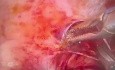 Resección de nódulo endometriósico en el ligamento uterosacro