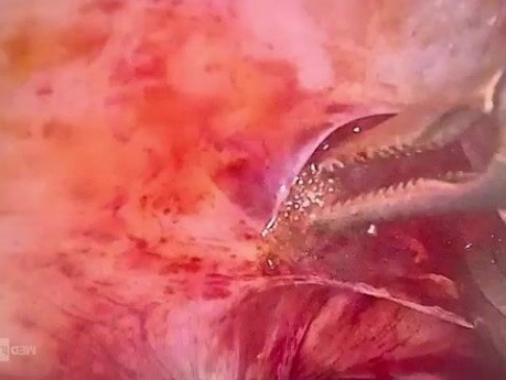 Resección de nódulo endometriósico en el ligamento uterosacro