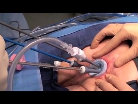 Cirugía mínimamente invasiva transanal con modificación