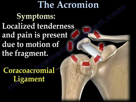 Tratamiento del os acromiale