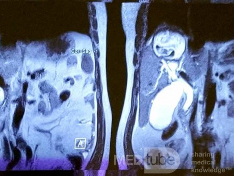 Quiste hidatídico hepático, CBC y colangitis, extracción de quiste hijo con CPRE