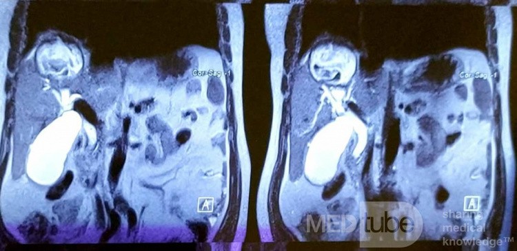 Quiste hidatídico hepático, CBC y colangitis, extracción de quiste hijo con CPRE