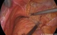 Caso quirúrgico de estenosis ureteral izquierda larga