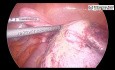 Torsión Ovárica - Ooforectomía Laparoscópica