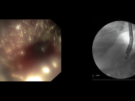 Gastrostomía pancreática