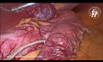 Hemangioma hepático gigante como incidentaloma en un caso de gastrectomía en manga