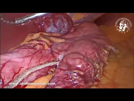 Hemangioma hepático gigante como incidentaloma en un caso de gastrectomía en manga