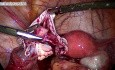 Quiste dermoide - extirpación laparoscópica 