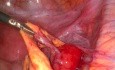 Tumor limítrofe de origen muscular y tumor recurrente
