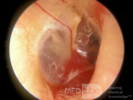 Glomus timpánico - oído medio derecho