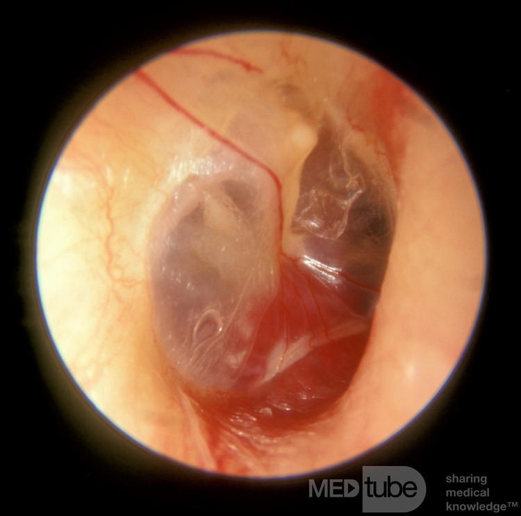 Glomus timpánico - oído medio derecho