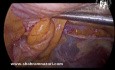 Cirugía laparoscópica de hernia de pantalón