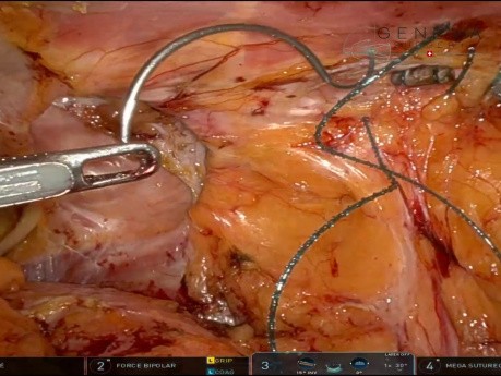 Reparación robótica TAPP de hernia incisional lumbar (flanco) L4 W2