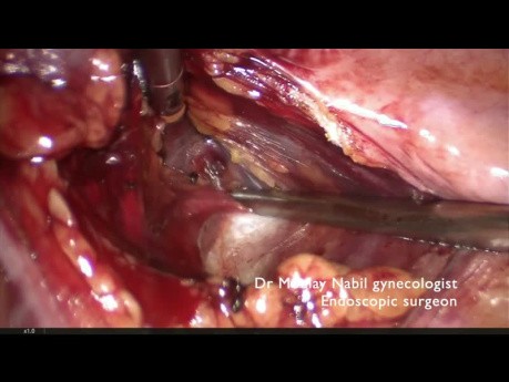 Miomectomía laparoscópica del ligamento ancho