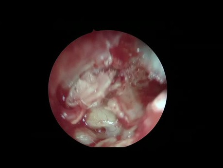 Abordaje combinado del colesteatoma endoscópico: transcanal + transmastoideo