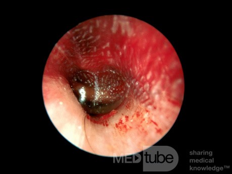 Miringitis bullosa, caso 3