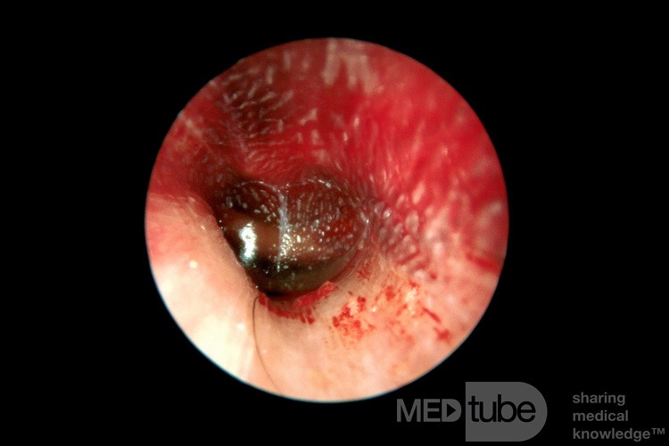 Miringitis bullosa, caso 3