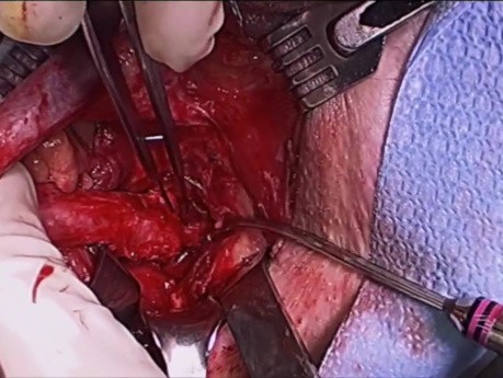 Uretroplastia posterior con colgajo del músculo gracilis