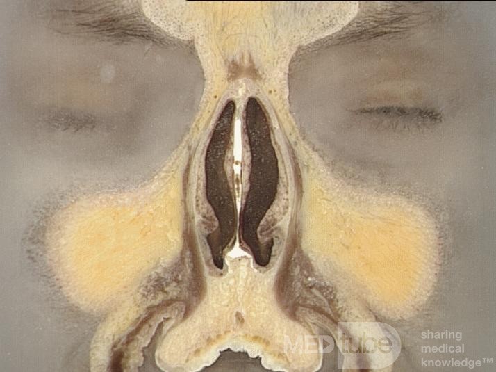 Anatomía coronal de la nariz y los senos paranasales: Corte 1
