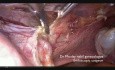 Histerectomía laparoscópica subtotal paso a paso