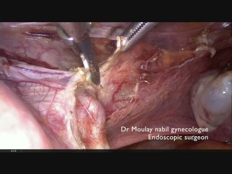 Histerectomía laparoscópica subtotal paso a paso