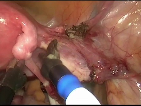 Histerectomía vaginal asistida por robot
