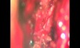 Microdiscectomía lumbar