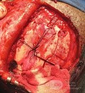 Planificación quirúrgica con neuronavegador en paciente con lesión de masa intracraneal. Glioma de alto grado.