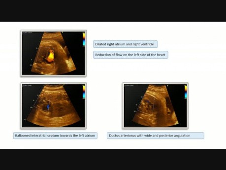 Foramen oval restrictivo en periodo fetal y proceso post natal