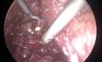 Prostatectomía radical laparoscópica conservadora de retizus