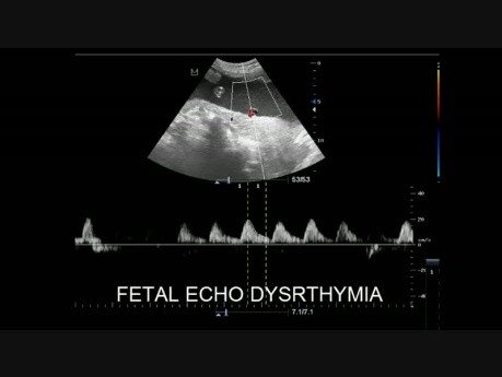 Disritmia fetal - ecografía
