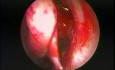 Sinusitis alérgica micótica - tratamiento endoscópico
