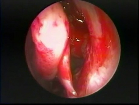 Sinusitis alérgica micótica - tratamiento endoscópico