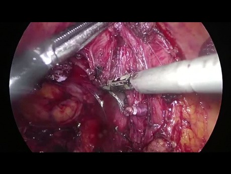 Escisión mesocólica completa laparoscópica (EMC) - Hemicolectomía derecha