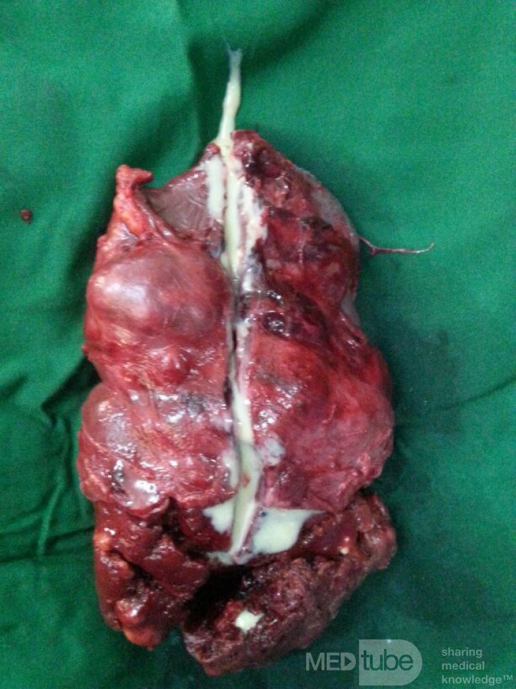 Tuberculosis de bazo